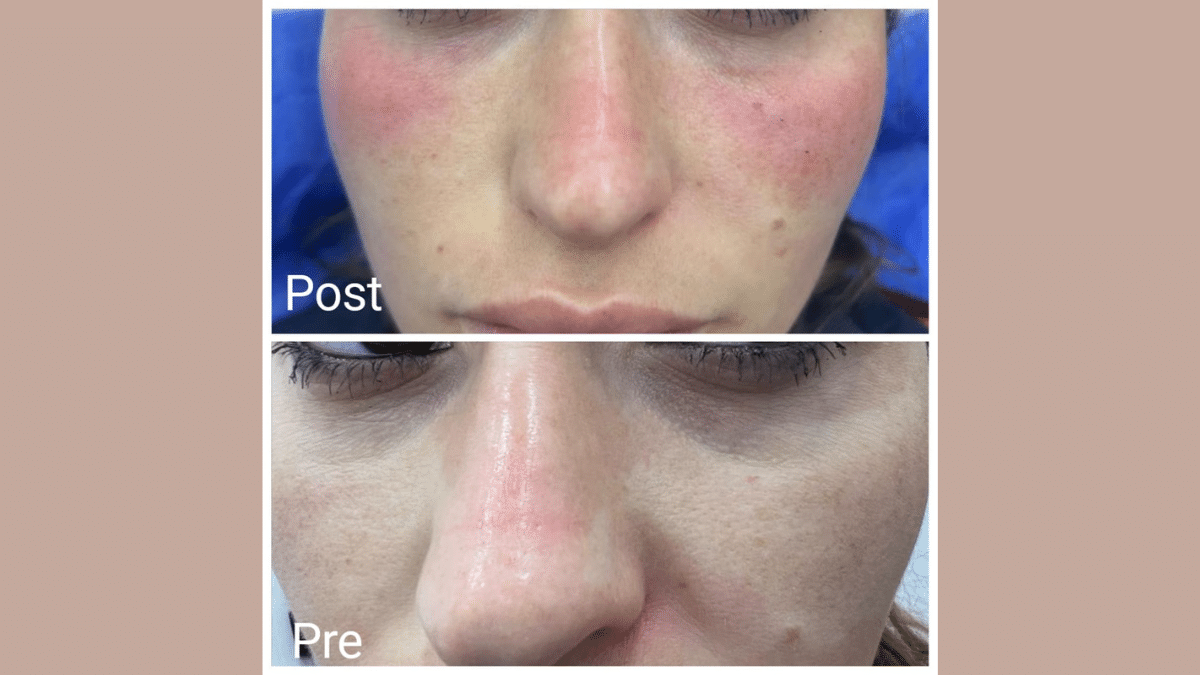 Dark circles treatment in Hurghada